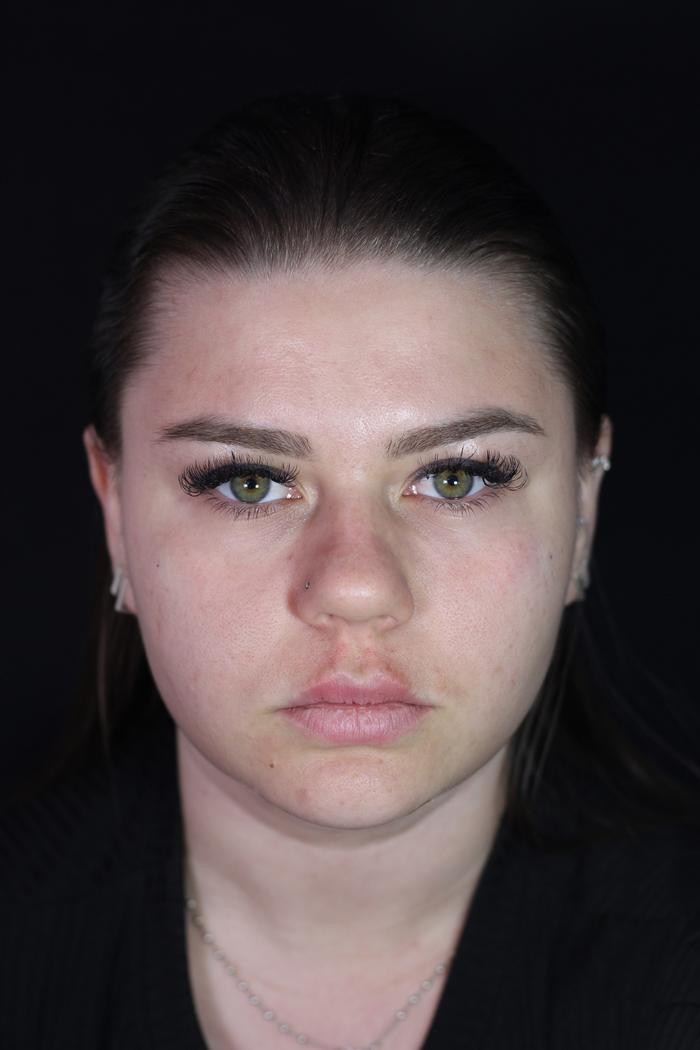 Antes · Harmonização facial full face Método Ramaz