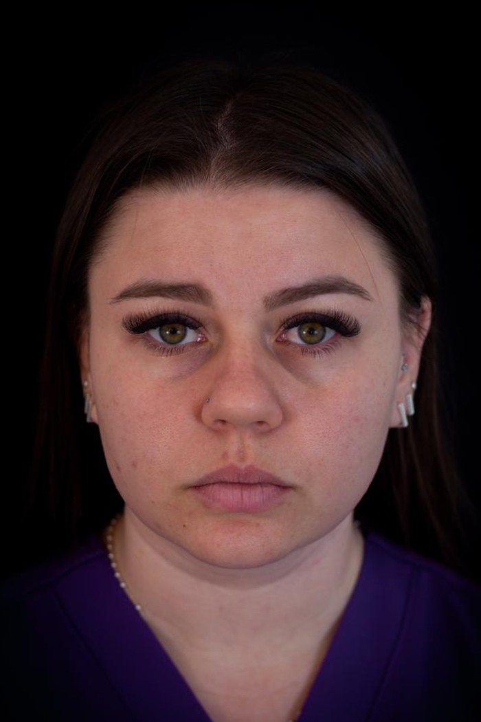 Depois · Harmonização facial full face Método Ramaz